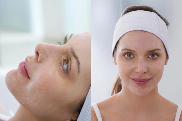 chemical-peel-houston-1-632x422-1