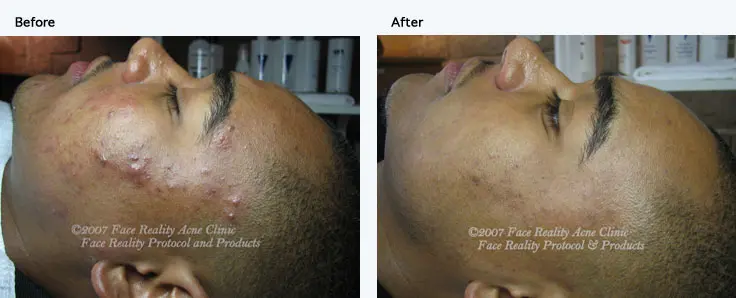 Before after image of acne clinic face reality protocol