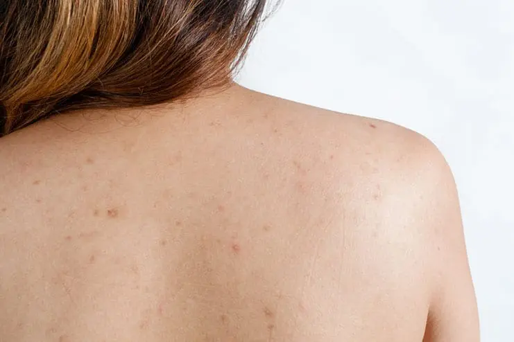 houston-back-acne-treatments