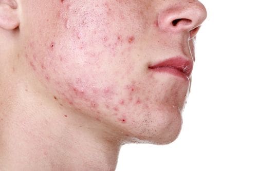 teenage-acne-treatments-in-houston